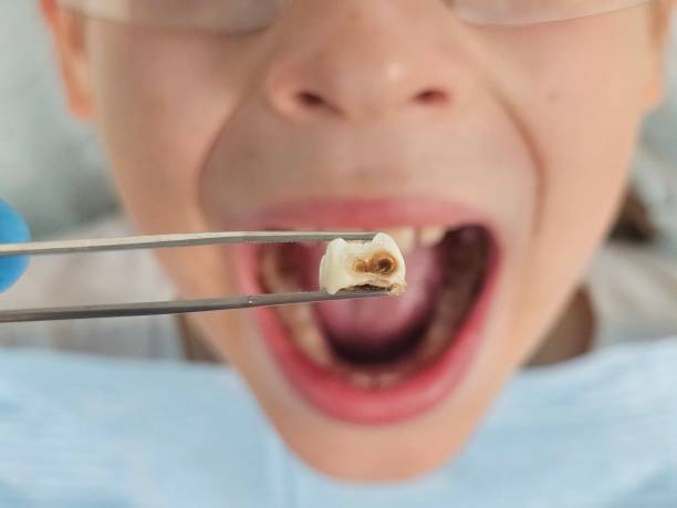 Best Urgent Dental Care for Toothache in Mechanicsville, MD